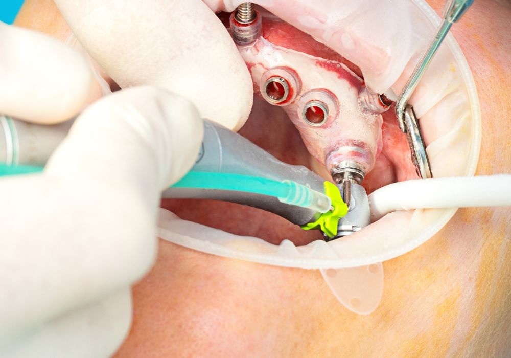 Cabinet dentaire IDRO - Sene - Morbihan - Guide chirurgical