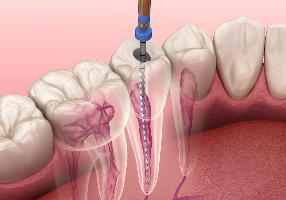 Cabinet dentaire IDRO - Sene - Morbihan - Endodontie