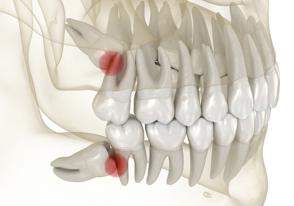 Cabinet dentaire IDRO - Sene - Morbihan - Extraction dents de sagesse