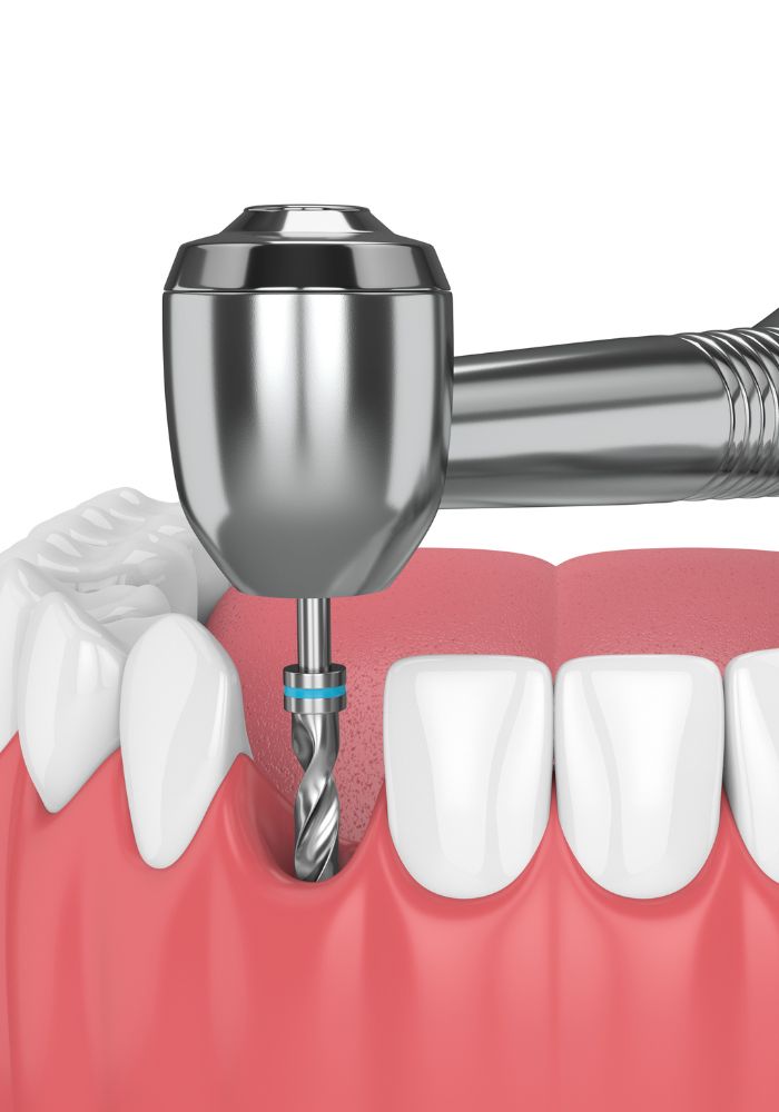 Cabinet dentaire IDRO - Sene - Morbihan - Pose implant dentaire