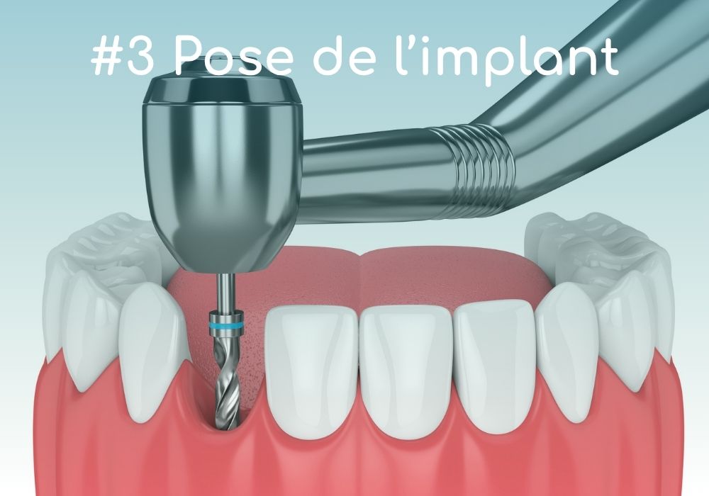Cabinet dentaire IDRO - Sene - Morbihan - Pose implant dentaire