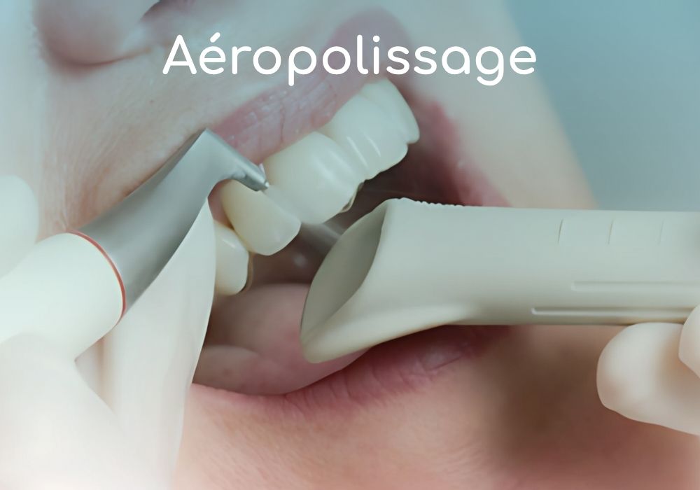 Cabinet dentaire IDRO - Sene - Morbihan - Aeropolissage dentaire