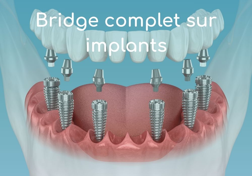 Cabinet dentaire IDRO - Sene - Morbihan - Bridge complet sur implant dentaire