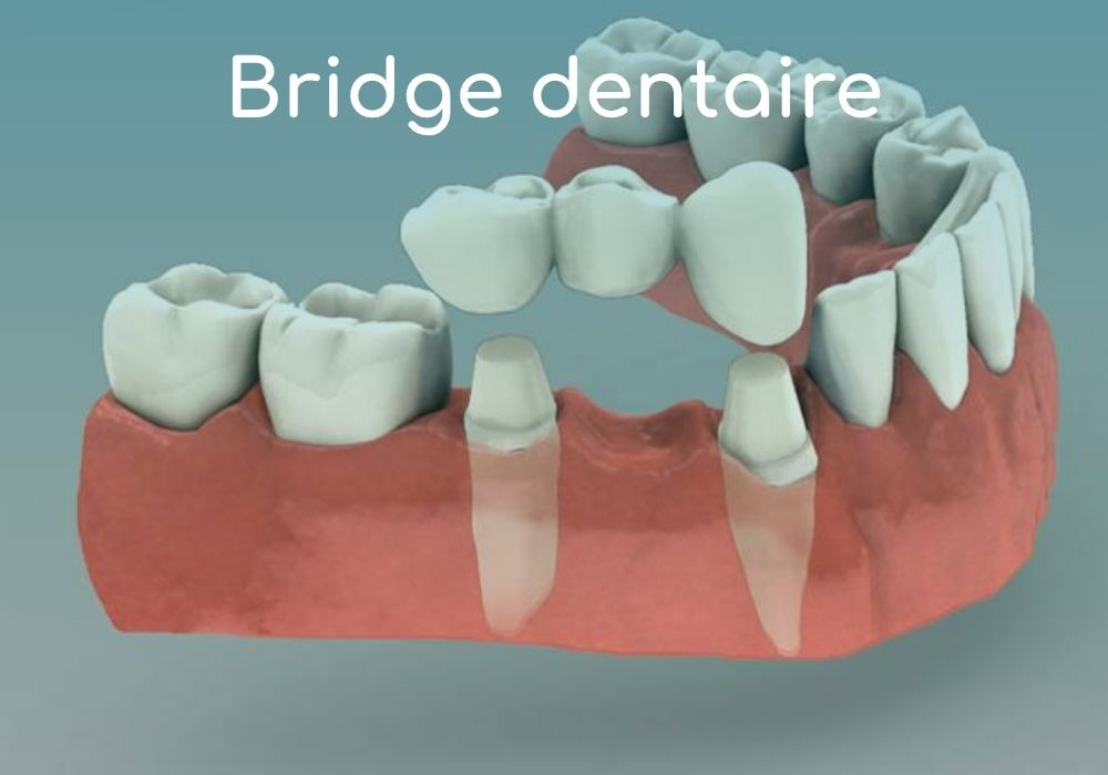 Cabinet dentaire IDRO - Sene - Morbihan - Bridge dentaire