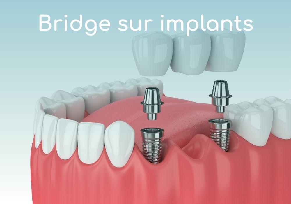 Cabinet dentaire IDRO - Sene - Morbihan - Bridge sur implants