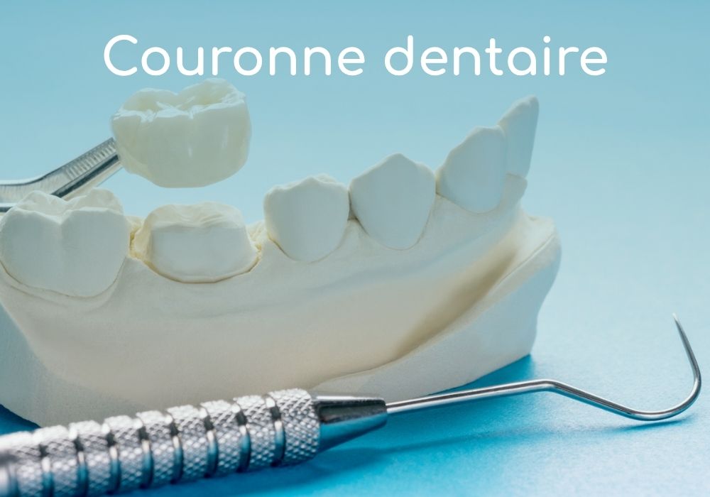 Cabinet dentaire IDRO - Sene - Morbihan - Couronne dentaire