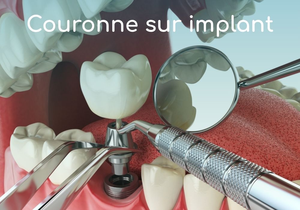 Cabinet dentaire IDRO - Sene - Morbihan - Couronne sur implant
