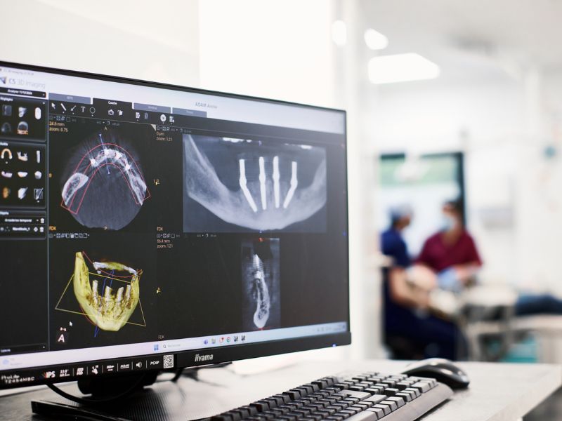 Cabinet dentaire IDRO - Sene - Morbihan - Implant dentaire