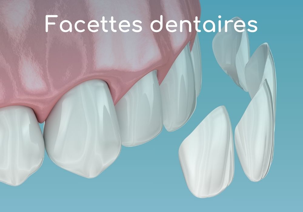 Cabinet dentaire IDRO - Sene - Morbihan - Facette dentaire