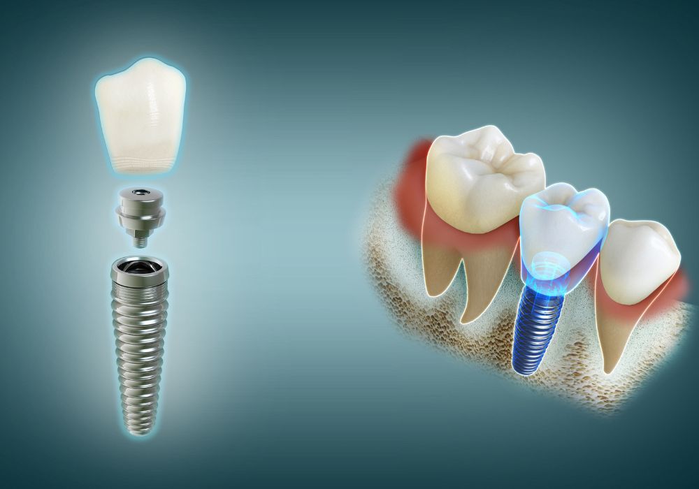 Cabinet dentaire IDRO - Sene - Morbihan - Implant dentaire