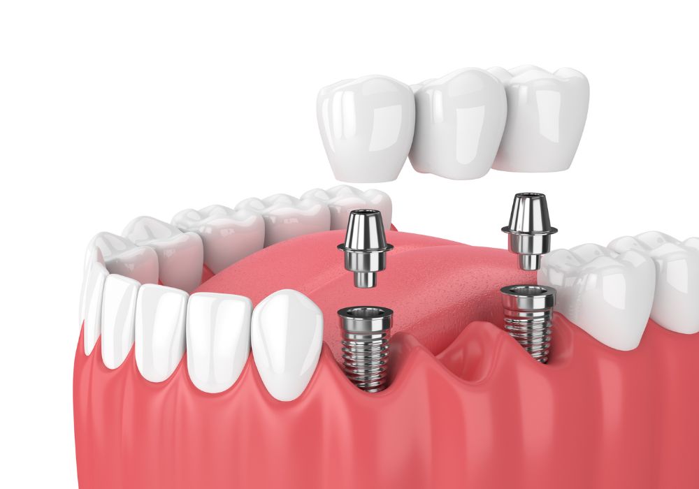Cabinet dentaire IDRO - Sene - Morbihan - Bridge sur implant