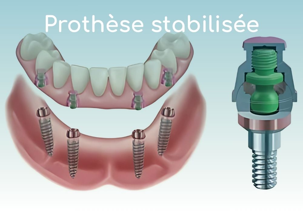 Cabinet dentaire IDRO - Sene - Morbihan - Implant dentaire