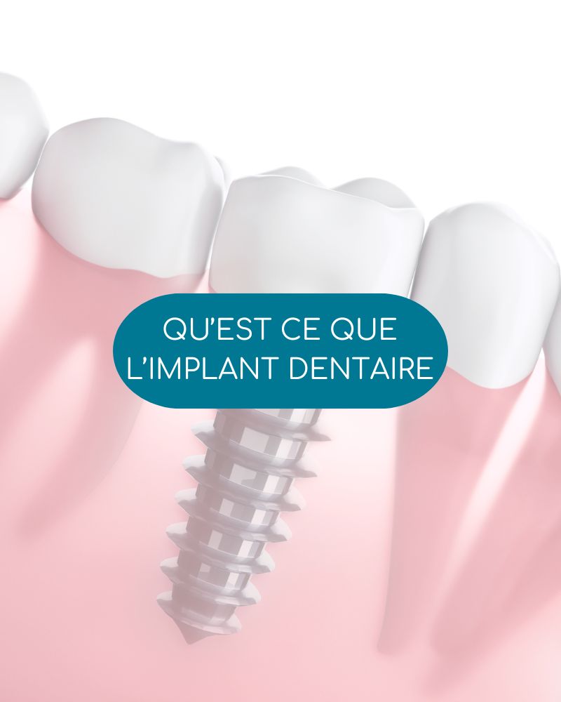 Cabinet dentaire IDRO - Sene - Morbihan - Implant dentaire