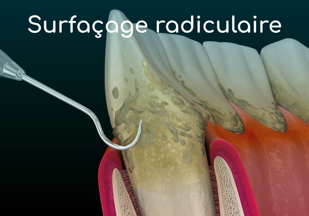 Cabinet dentaire IDRO - Sene - Morbihan - Surfacage radiculaire